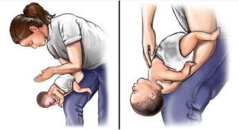 Bebeklerde hava yolu tıkanıklığı (Heimlich Manevrası)